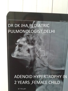 adenoid hupertrophy 2