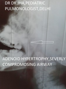 adenoid hypertrophy